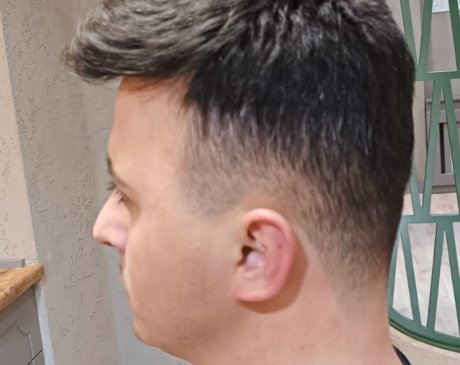 protez sac oncesi ve sonrası