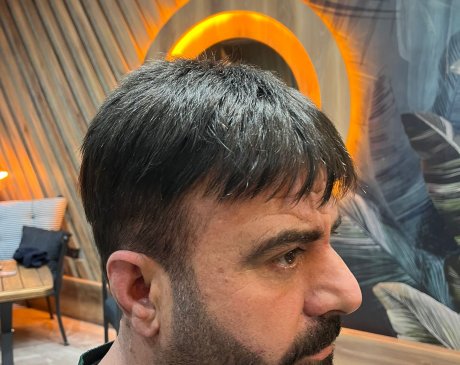 protez sac oncesi ve sonrası