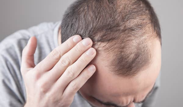ALOPECIA (SAÇ KAYBI)
