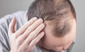 ALOPECIA (SAÇ KAYBI)